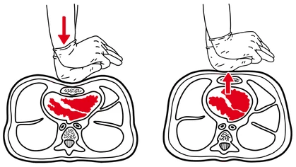 CPR compression, pressing straight down onto the chest to a depth of 5 cm or more on an adult